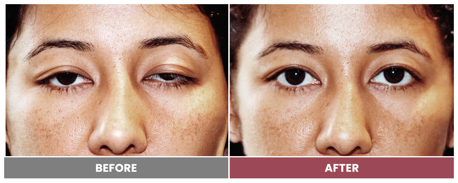 PTOSIS REPAIR - Case 21
